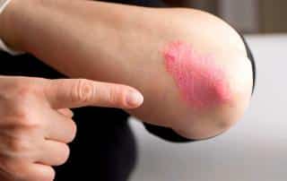 Psoriasis y los beneficios del sol para paliar sus síntomas