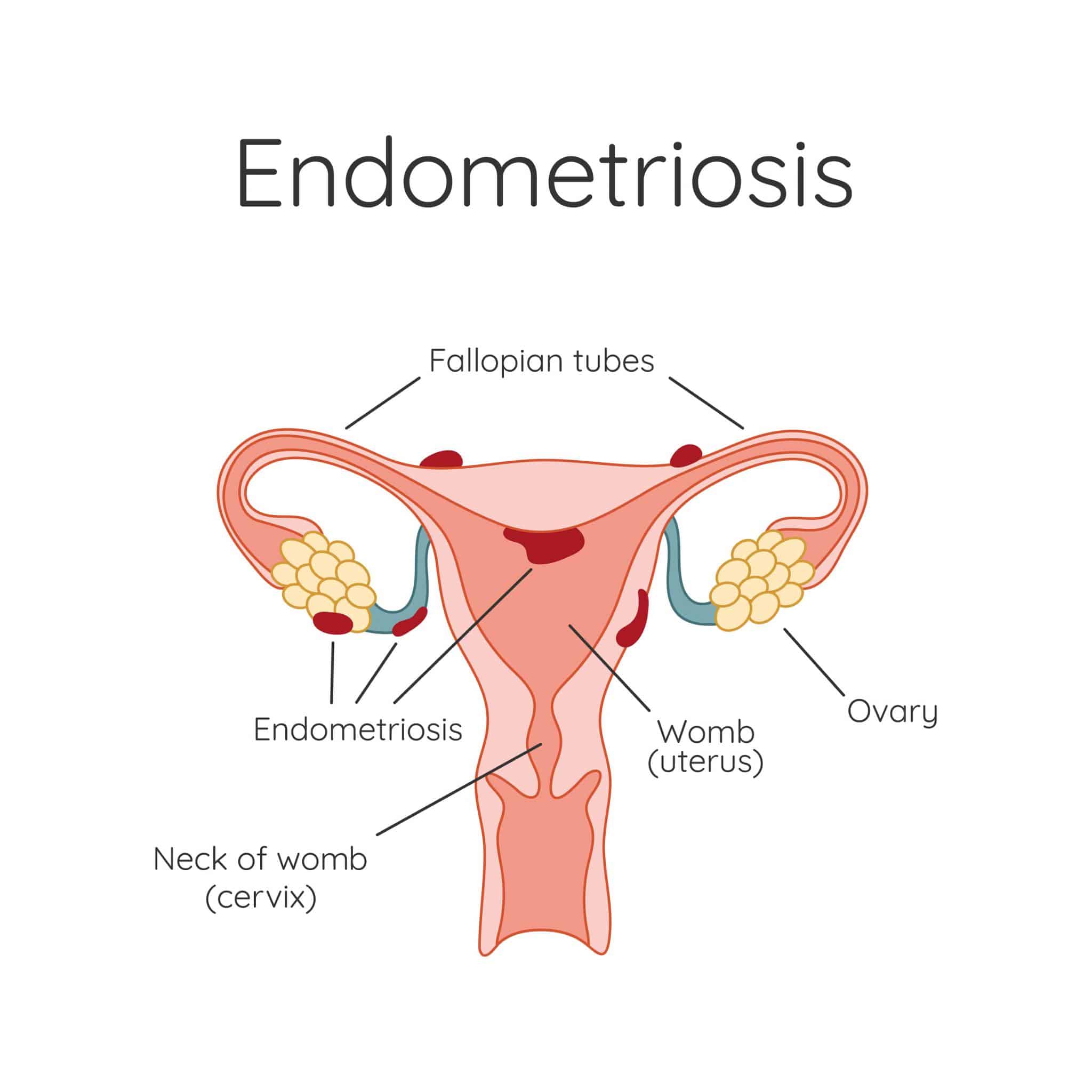 endometriosis