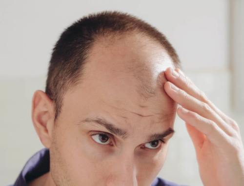 Tipos de alopecia: causas y tratamientos